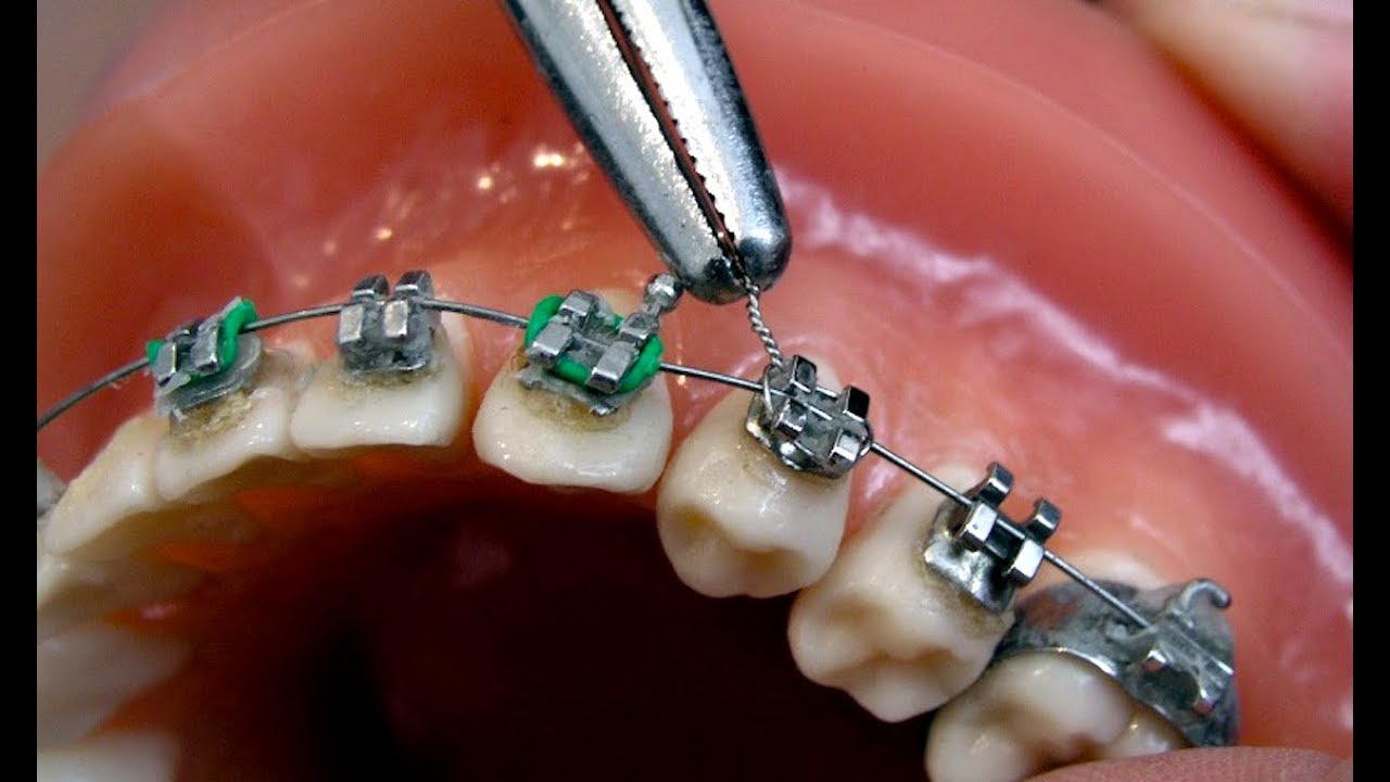 Ортодонтия что это. Брекеты металлические лигатурные (2 челюсти). Лигатура ортодонтическая.
