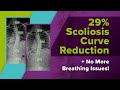 29% Scoliosis Curve Reduction   No More Breathing Issues!