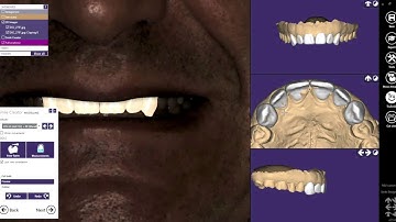 Part 1: Aesthetic design planning - smile with Exocad Matera 2.3