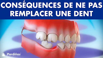 Comment mettre des fausses dents ?