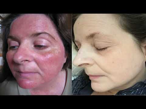 Learn about rosacea | what is acne rosacea