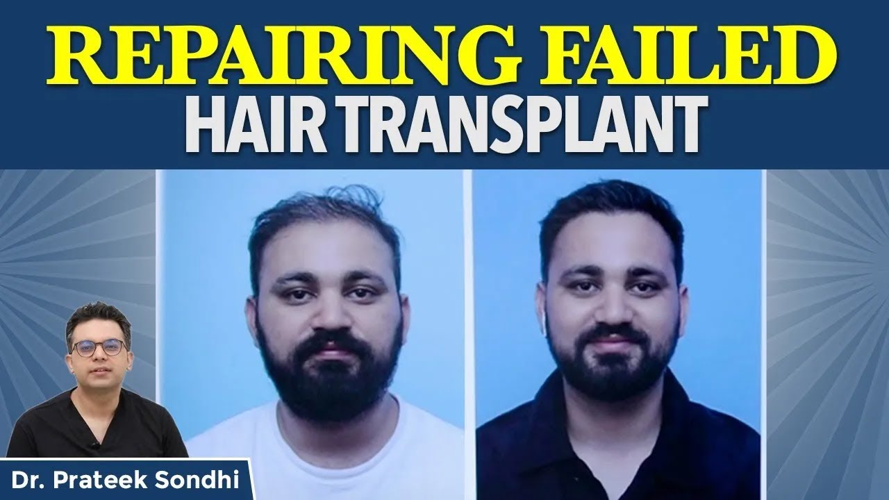 🔴Failed Hair Transplant | Corrective Surgery for Failed Hair Transplant | Results and Repair