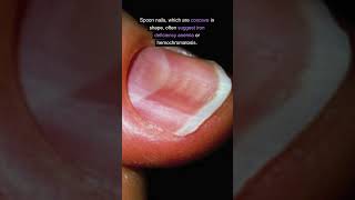 Clubbing Fingers Spoon Nails uncover five crucial signs  #ClubbingFingers, #SpoonNails, #Nails