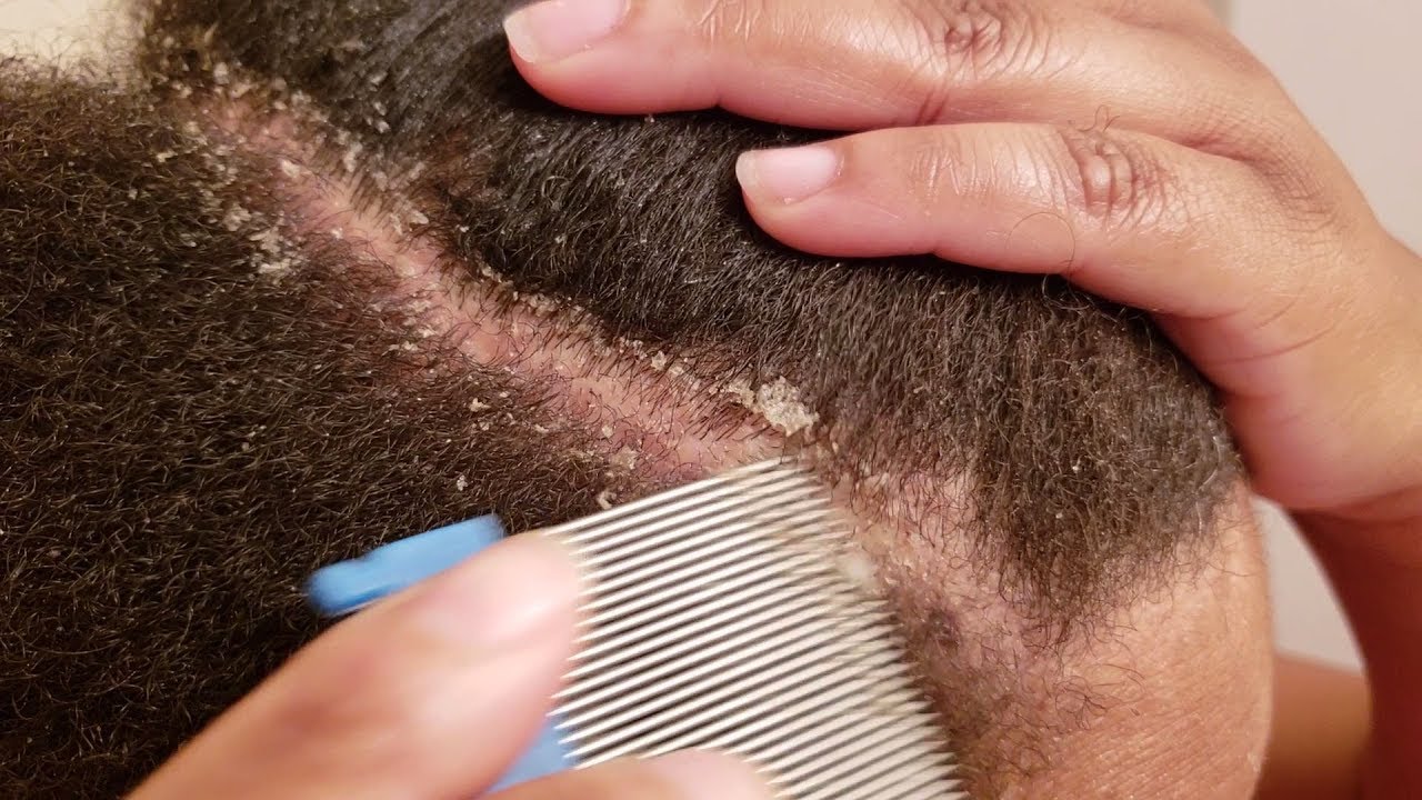 dandruff removal with lice comb