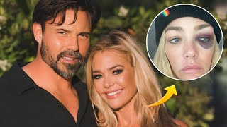 Denise Richards Exposes Domestic Abuse: Shocking Black Eye Photos Revealed!
