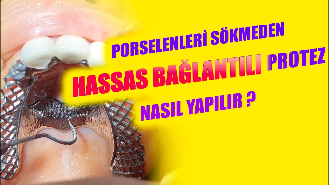 Porselenler Değişmeden Hassas Bağlantılı Protez Nasıl Yapılır?