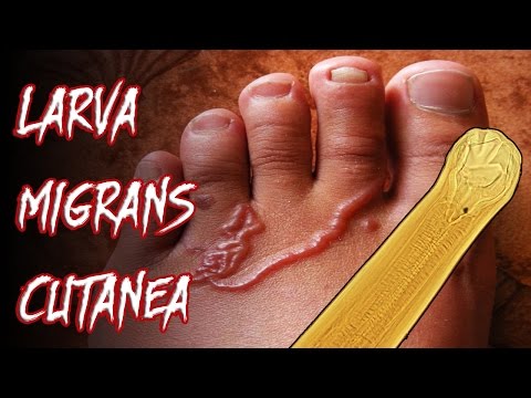 Vídeo: Vermox: Cómo Salen Los Gusanos, Reglas De Admisión, Curso De Tratamiento