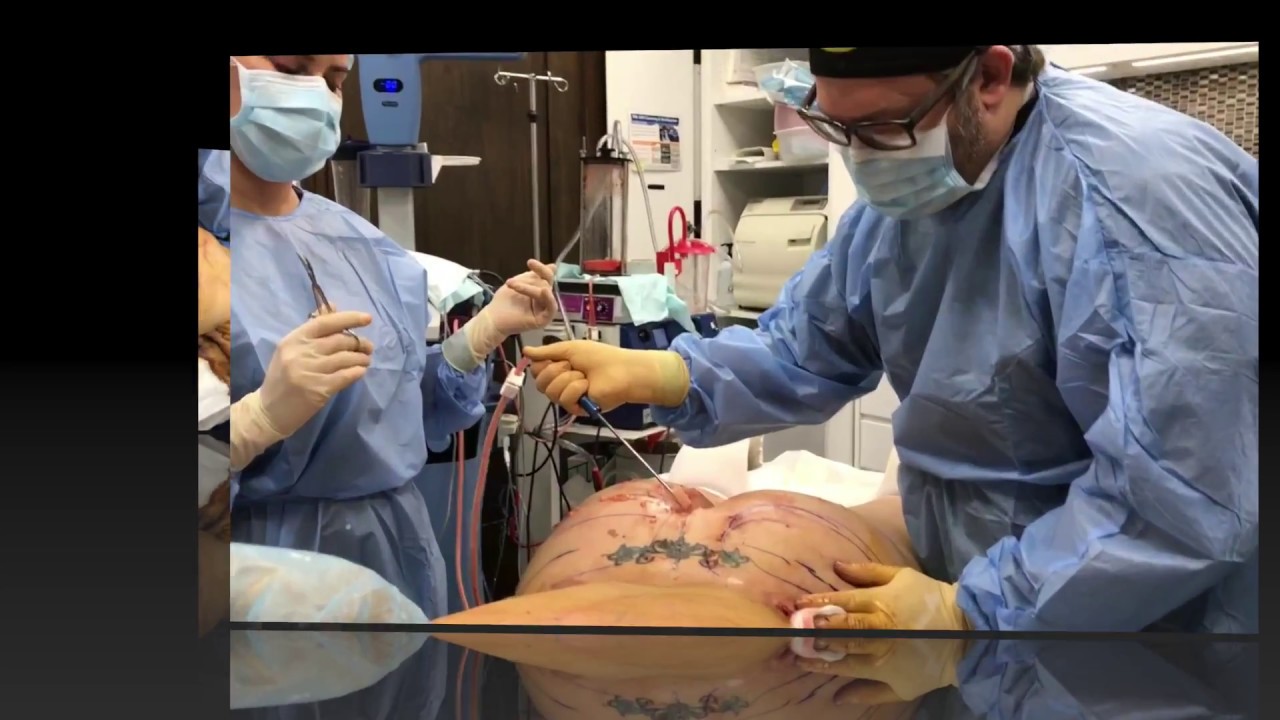 High Definition Liposuction In Office In New Jersey YouTube