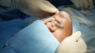 Male Facial Sculpting | Jawline, Chin, Face Surgery - Dr. Sunil Richardson