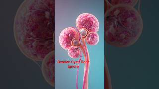 “Most Women Have Ovarian Cysts Without Knowing! ⚠️ Symptoms &amp; Truth” #ovariancyst #ovarianreserve