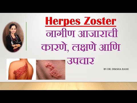 Herpes Zoster | नागीण आजाराची कारणे, लक्षणे आणि उपचार