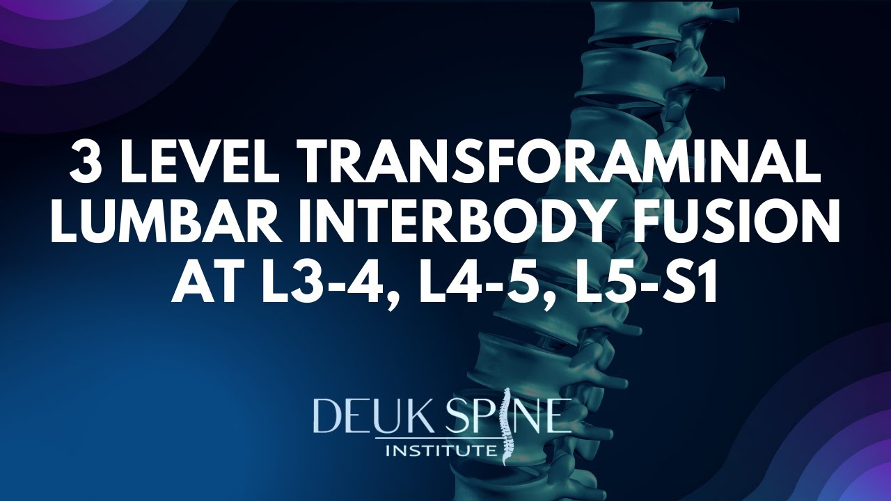 3-level-tlif-at-l3-4-l4-5-l5-s1-of-the-lumbar-spine-youtube