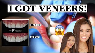 I GOT VENEERS + GUM LIFT PROCEDURE