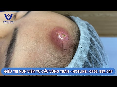 ĐIỀU TRỊ MỤN VIÊM TỤ CẦU VÙNG TRÁN, CAM KẾT HIỆU QUẢ SAU 1 BUỔI,  KHÔNG THÂM, KHÔNG ĐỂ LẠI SẸO.