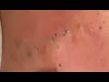 Чёрные точки / Релакс / Выдавливание прыщей / #Прыщи #чёрнаяточка