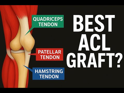 What Is the Best ACL Graft Choice? Patellar vs Quad vs Hamstring Tendon Explained