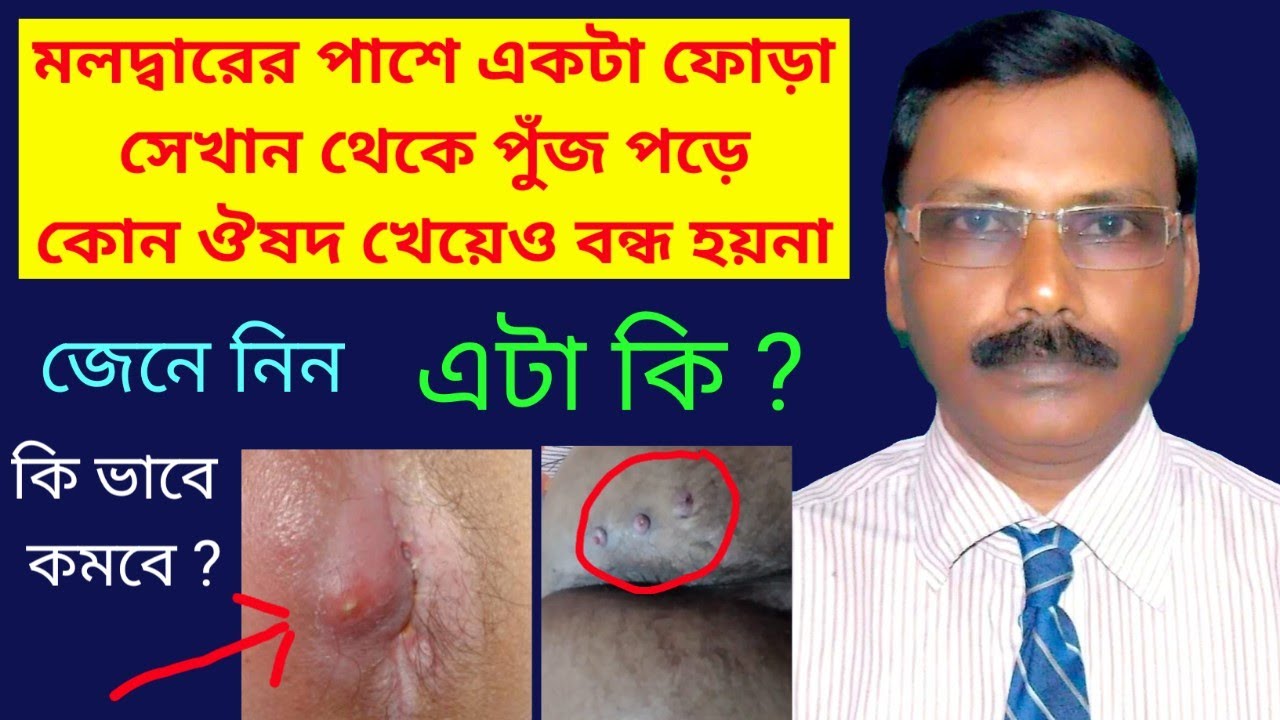 Anal jinsiy aloqadan keyin jinsiy olatni shishishi