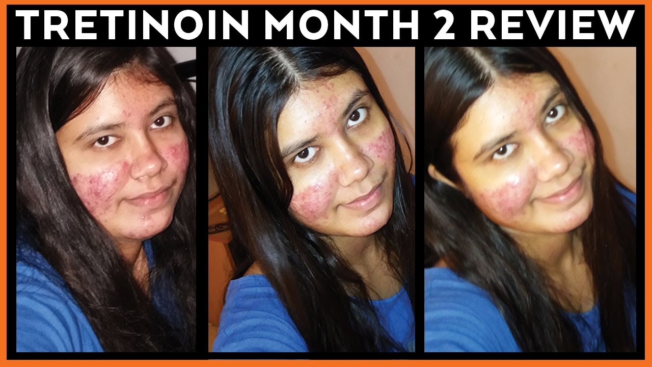 RETIN A / TRETINOIN MONTH 2 REVIEW (WITH IMAGES)