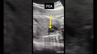 Ultrasound showing fetal heart!Femur Length!Obstetric Ultrasound!#ultrasoundmadeeasy86#radiology#usa