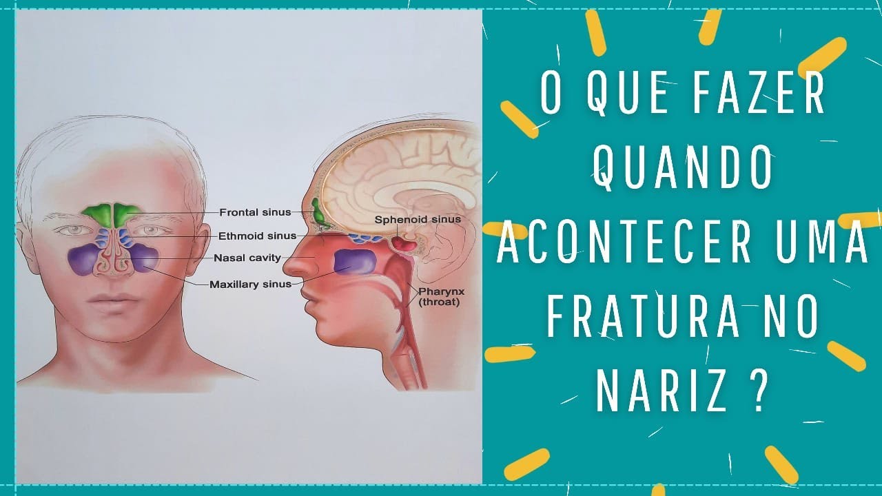 SAIBA O QUE FAZER QUANDO OCORRER UMA FRATURA NO NARIZ - YouTube