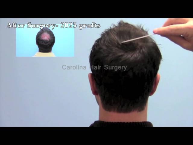 Excellent Hair Transplant of the Crown with FUE Hair Transplant