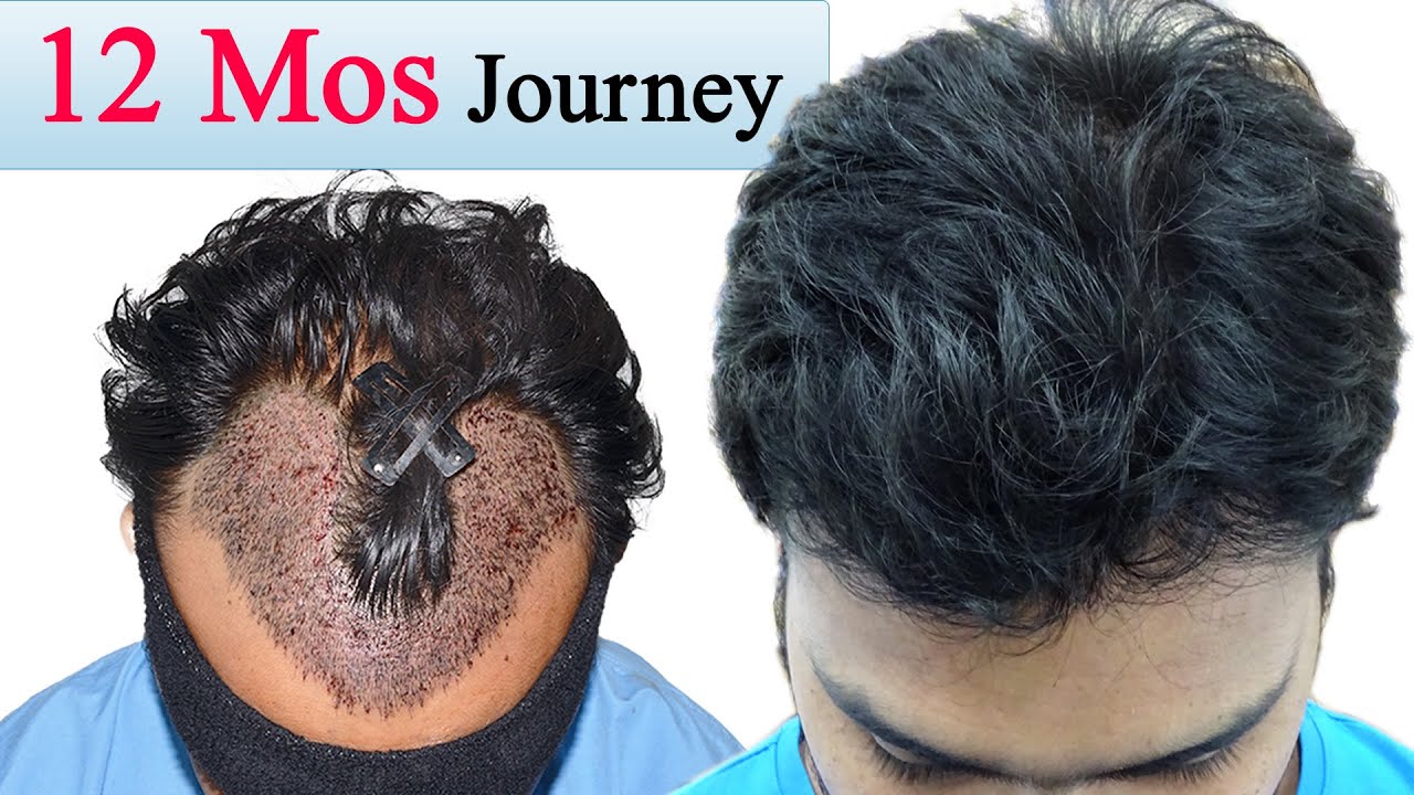 Hair Transplant in Thrissur  Hair Transplant Cost in Thrissur