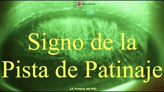 Signo de la Pista de Patinaje (Ice Rink Sign). Erosión corneal.