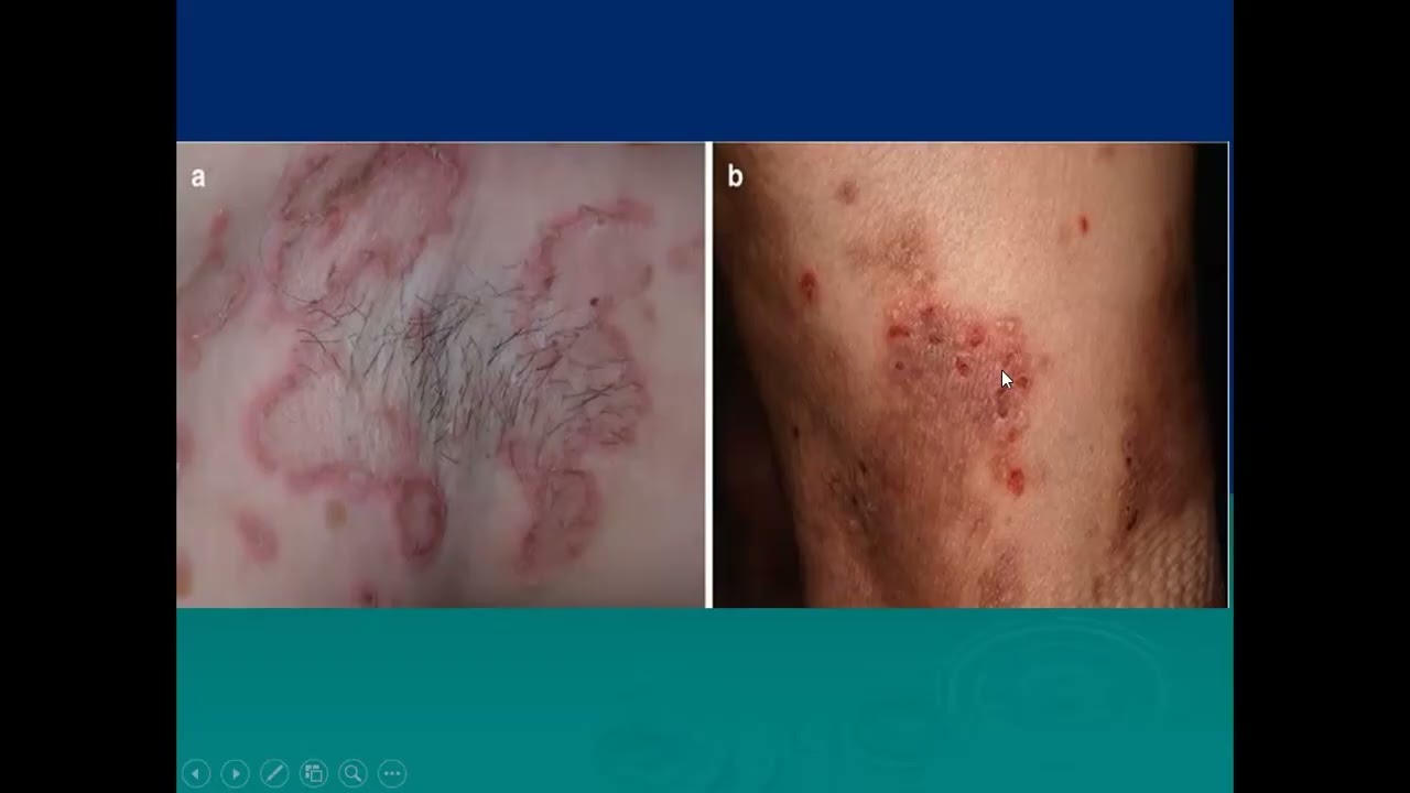 Lecture No. 238: MAKING CLINICAL DIAGNOSIS ON THE BASIS CLINICAL SYNDROMES. Part-2