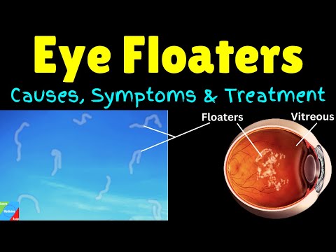 What are Eye Floaters? - Causes, Symptoms, Treatment & Prevention