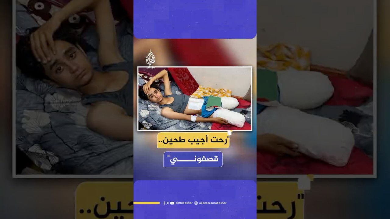 طفل فلسطيني نازح من حي الشجاعية حاول جلب الطحين لعائلته فكان ضحية قصف إسرائيلي تسبب في بتر ساقيه