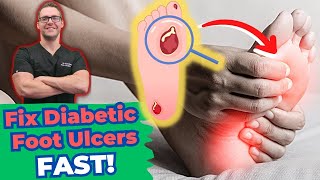 Diabetic Foot Ulcer Treatment & Early Stages [Diabetic Neuropathy]