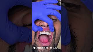 Zirconia Caps Transformation 😍 Smile Correction Result! | Indore