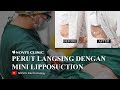 Perut langsing dengan mini liposuction by dr novi arlisma  novis dermatology