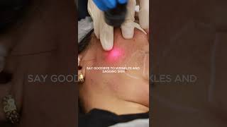 How Can It Be Real? Get Younger Skin Without Surgery with Endolift! #beforeandafter #transformation