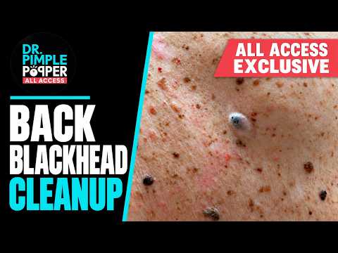 ALL ACCESS EXCLUSIVE | Back Blackhead Cleanup | Dr. Pimple Popper