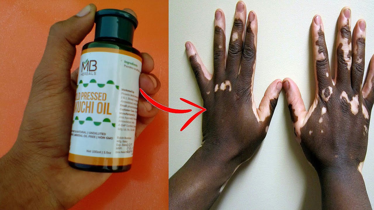 सफेद दाग ठीक करने की अचूक दवा ! सफेद दाग अब सदा के लिये खत्म हो जायेगा// safed daag ka ilaj - YouTube