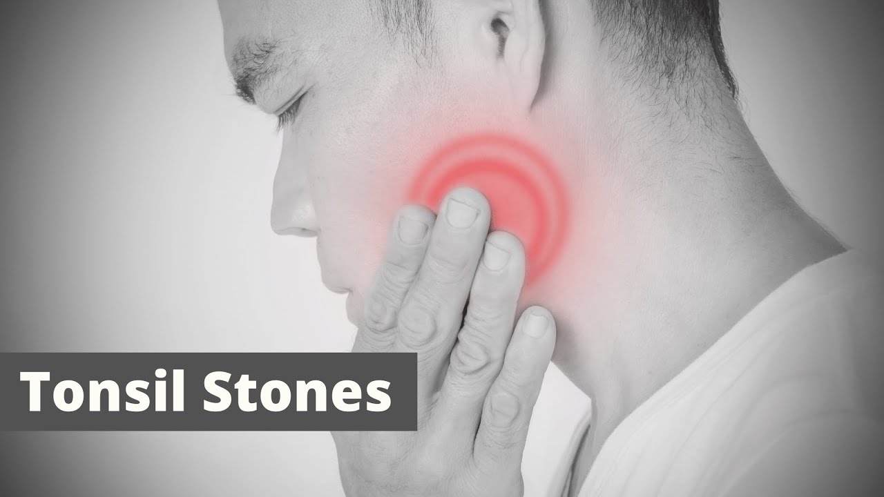 Tonsil Stones Meaning Word pronounce English Speaking English