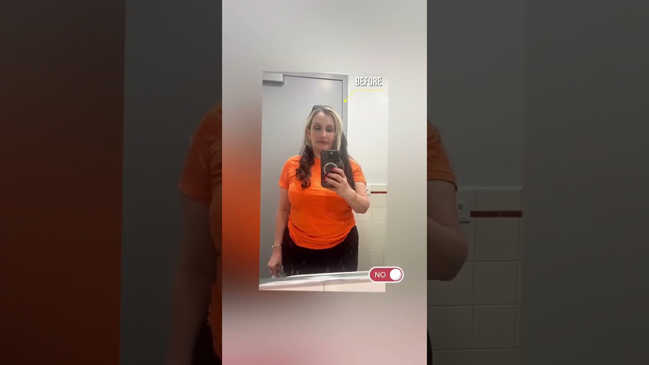 Amazing 2-Month Results: Lipo360 + BBL with Dr. Shanklin #smartplasticsurgery #miami#beforeandafter