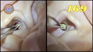 Professional Earwax Removal. Episode 169