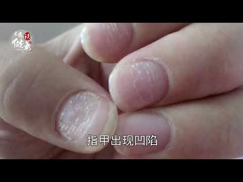 指甲上有斑或不平｜白斑：消化不良、缺钙、营养不足。断裂：缺钙、缺蛋白。凹或皱：牛皮癣、关节炎。纵沟甲：过劳，神经衰弱。横沟甲：营养不良，熬夜、吃饭不规律。黑斑甲：肿瘤、坏疽、血液循环障碍【老安谈健康】