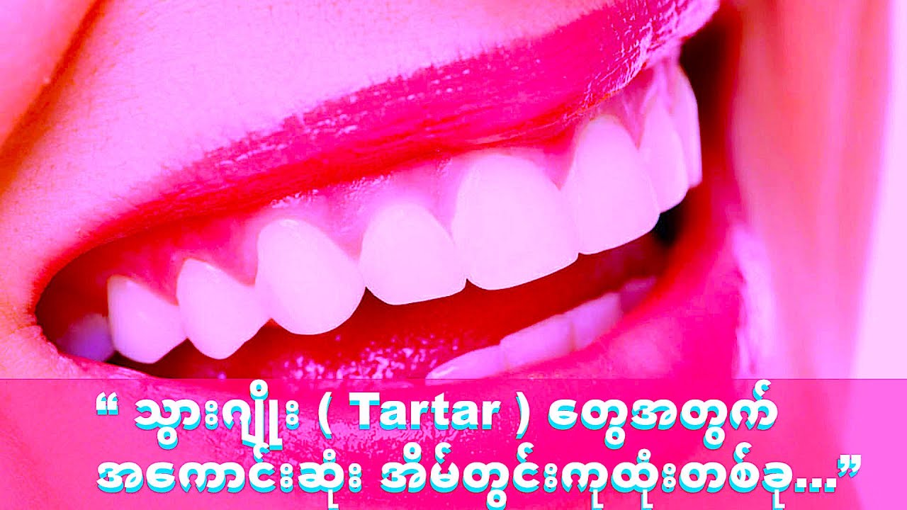 “ သွားဂျိုး ( Tartar ) တွေအတွက် အကောင်းဆုံး အိမ်တွင်းကုထုံးတစ်ခု...”