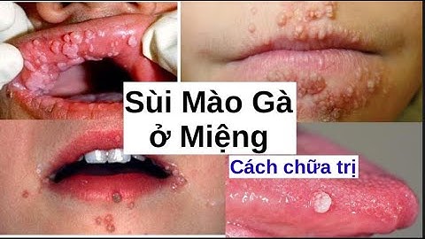 Chữa sùi mào gà ở miệng bằng cách nào