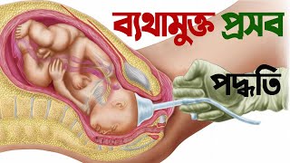 ব্যথামুক্ত প্রসব - ব্যাথামুক্ত প্রসব পদ্ধতি | ব্যথামুক্ত প্রসব বা পেইনলেস ডেলিভারি | normal delivery