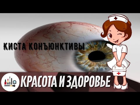 Видео: В своде конъюнктивы?