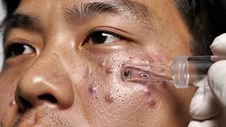 Blackhead Removal Ritual | Relaxing Self-Care