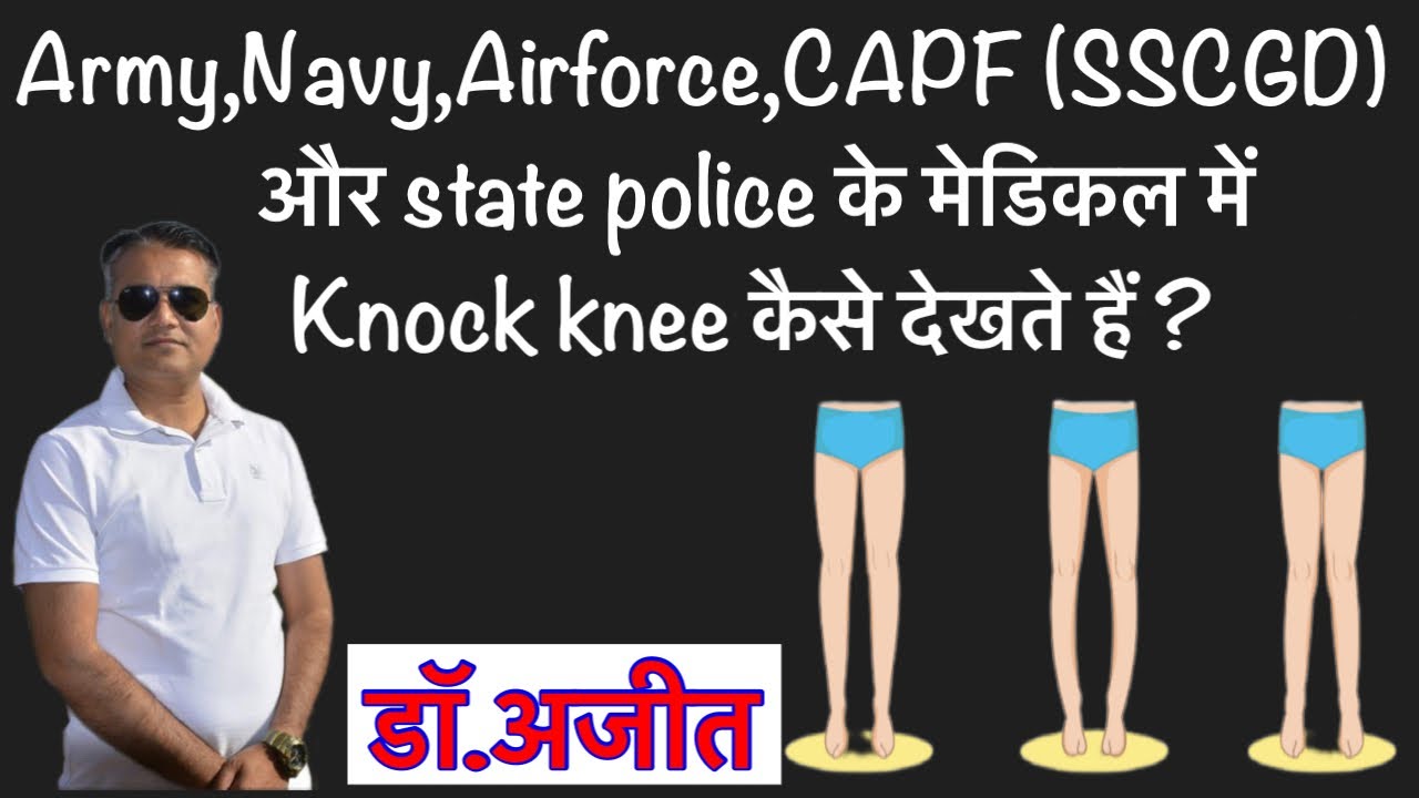 ARMY,CAPF(SSB,CRPF etc.)STATE POLICE में बहाली के लिये Knock knee,Bow leg,Genu recurvatum की