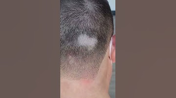 Scalp Micropigmentation - Fixing Scars