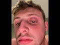 How W2S got his black eye