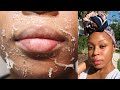 CHEMICAL PEEL EXPERIENCE | The Process, Peeling, + Before & After | No More Acne & Dark Marks!