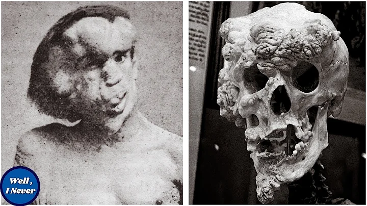 The Tragic Story of The 'Elephant man' Joseph Merr...